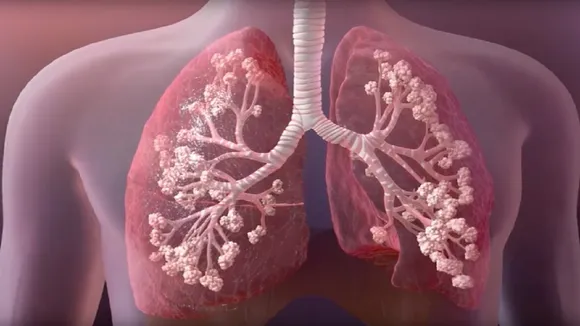 Cystic Fibrosis