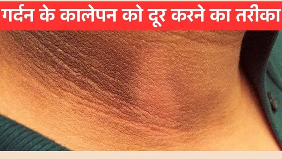 Dark Neck Remedies