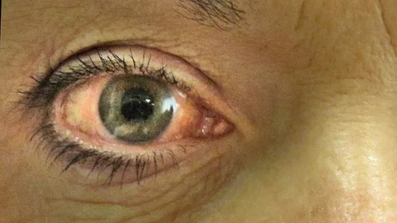glaucoma treatment