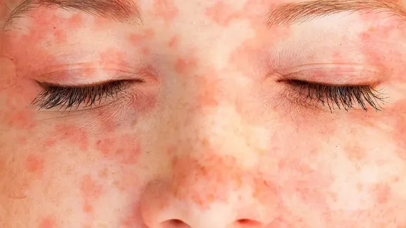 Dermatomyositis