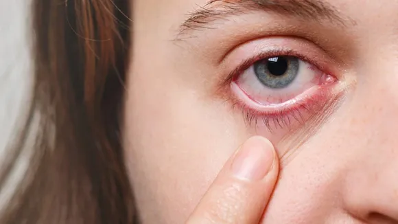 Dry Eye Syndrome