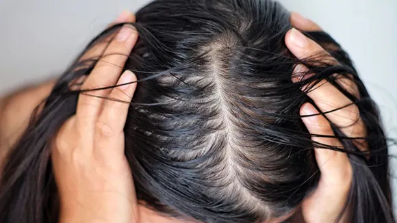 oily hair problem