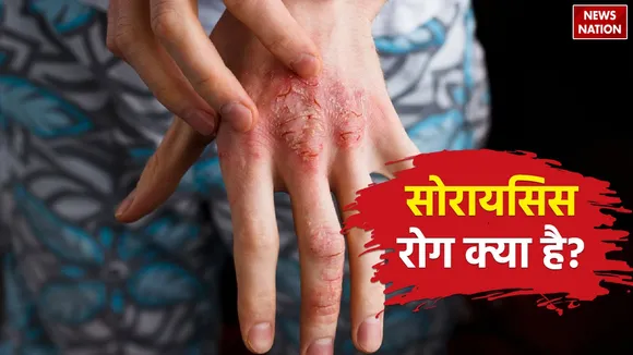 what is skin psoriasis