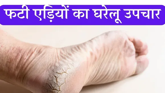 Cracked heels home remedies