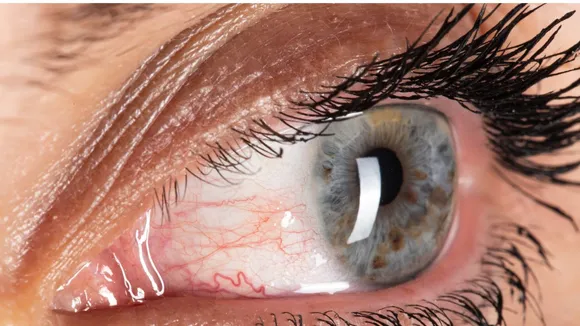 Eye Flu Home Remedies