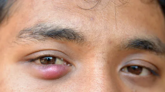 Stye Treatment