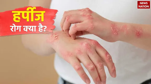 Herpes Disease