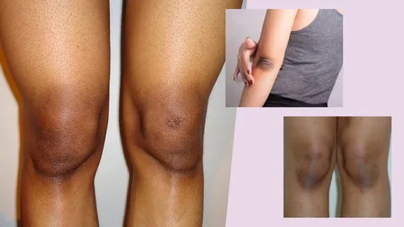 Home Remedies to naturally lighten Dark Knees