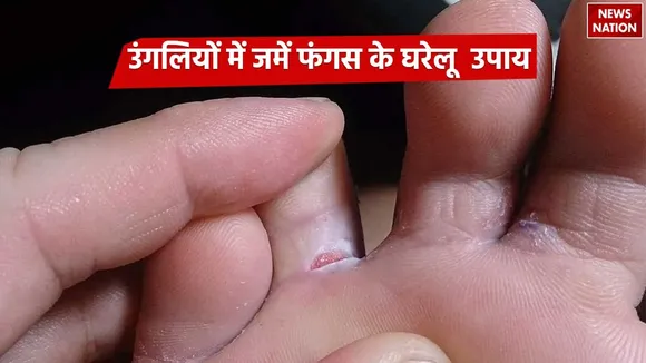 Fungus In Finger Treatment