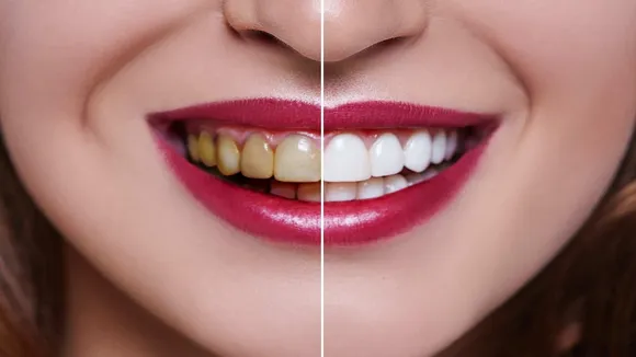 Teeth Whitening Tips