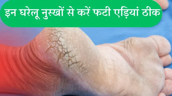 Cracked Heel Home Remedies