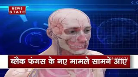 दिल्ली के बाद अब गुजरात में ब्लैक फंगस के नए मामले