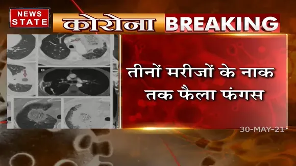 Black Fungus: बिलासपुर में ब्लैक फंगस के तीन मरीज आए सामने