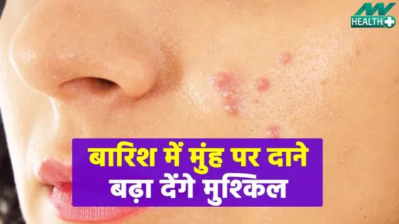 बारिश के मौसम में होते अगर आपके फेस पर पिंपल, तो आजमाए यह नुख्सा