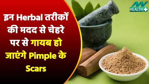इन Herbal तरीकों की मदद से चेहरे पर से गायब हो जाएंगे Pimple के Scars