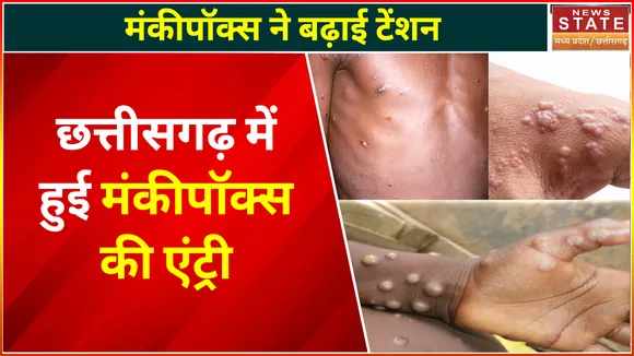 Monkey Pox in Chhattisgarh : छत्तीसगढ़ में मंकीपॉक्स की एंट्री !, रायपुर में दिखा बच्चे में लक्षण