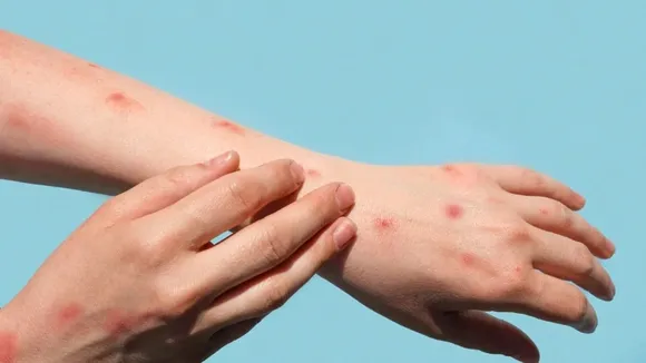 United States Declares Monkeypox As Public Health Emergency
