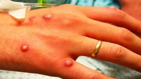 Another Case of Monkeypox Reported in Delhi, India’s 8th Case
