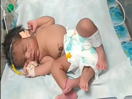 Baby Girl Born With Four Legs In MP's Gwalior