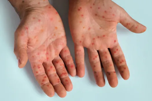Health Ministry Issues Advisory on "Mpox" Amid Global Surge