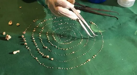 526 teeth removed from Chennai boy’s mouth!