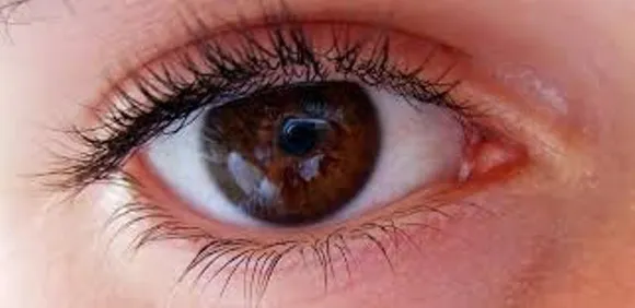 Vehicle Pollutants Heightened Risk for Common Eye Condition