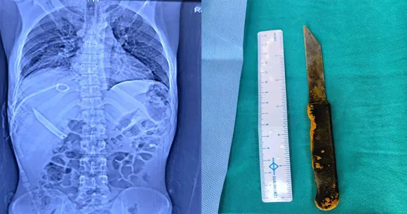 Knife removed from liver of Haryana man