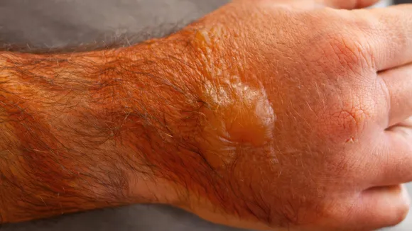 Skin Burn