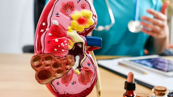 kidney cancer