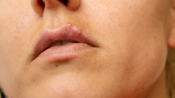 Girls moles