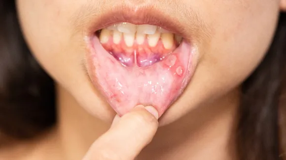 Oral cancer