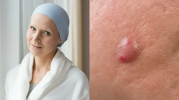 Skin Vs Bumps