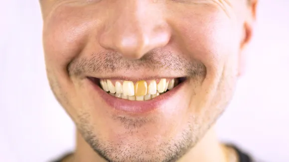 Yellow Teeth