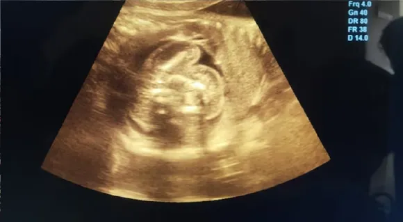 In one of 200 cases globally, foetus found inside unborn baby in Maharashtra