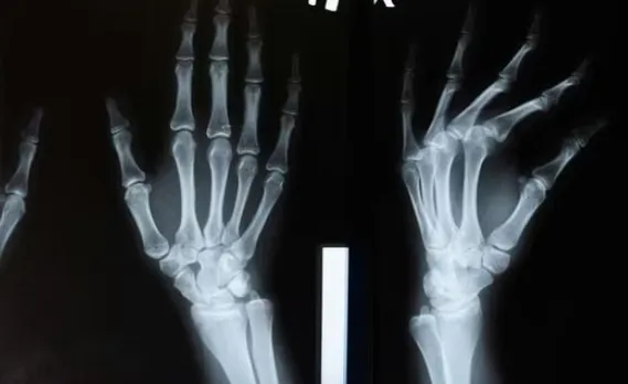 bone glu