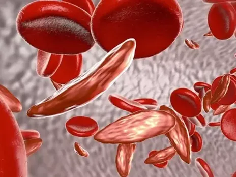 sickle cell anaemia