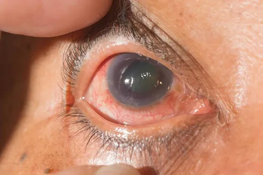 glaucoma eye