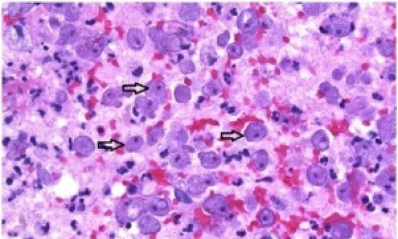amebic meningoencephalitis