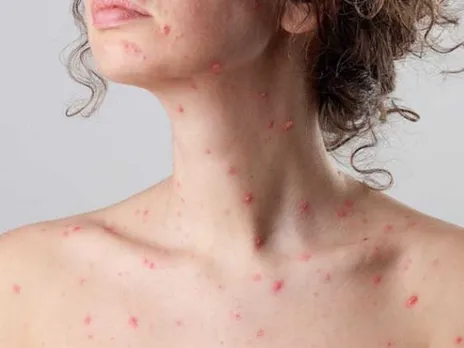 chicken pox.jpg