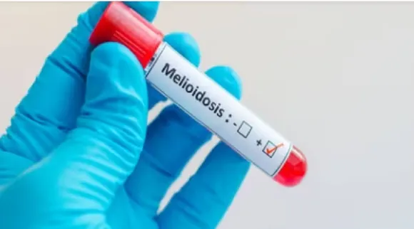 melioidosis