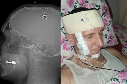 brain-surgery-.jpg