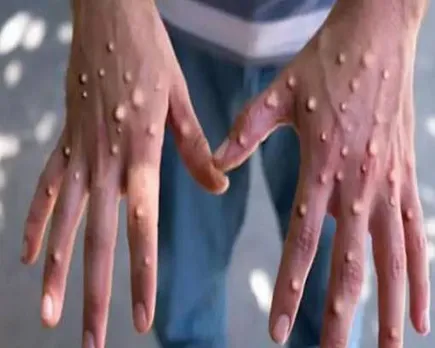 empox spread