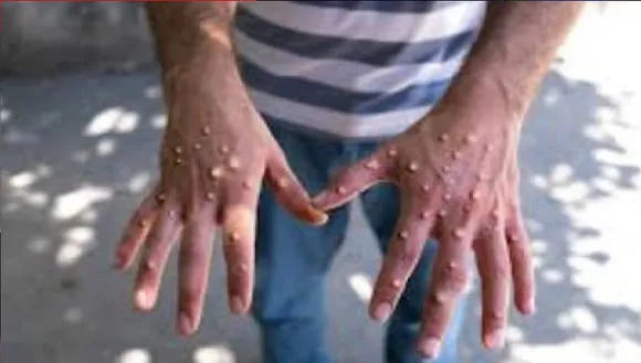 mpox Untitledona