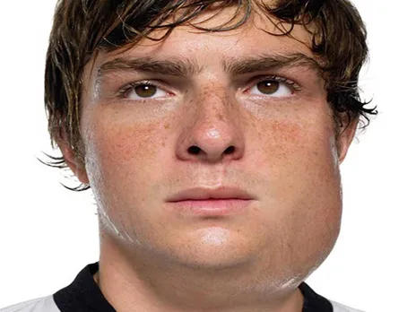 mumps.jpg