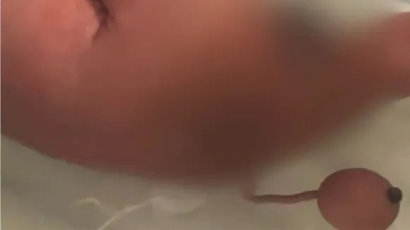 ഇത് അപൂർവ്വങ്ങളിൽ അപൂർവ്വം; ഡോക്ടർമാർക്കും ലോകത്തിനും അത്ഭുതമായി 12 സെന്റീമീറ്റർ നീളമുള്ള വാലുമായി കുഞ്ഞ് ജനിച്ചു