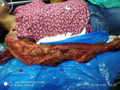 കാഞ്ഞിരപ്പള്ളി സ്വദേശിയായ മലയാളി നേഴ്സ് ബാംഗ്ലൂര്‍ യാത്രയ്ക്കിടെയുണ്ടായ അപകടത്തില്‍ സാരമായി പരിക്കേറ്റ് കോയമ്പത്തൂരില്‍ സ്വകാര്യ ആശുപത്രിയില്‍. ചികിത്സയ്ക്ക് പണമില്ലാത്തതിനാല്‍ സോഷ്യല്‍ മീഡിയ വഴി സഹായമഭ്യര്‍ഥിച്ച് സുഹൃത്തുക്കള്‍. ബാംഗ്ലൂരില്‍ നേഴ്സിംഗ് പഠനം കഴിഞ്ഞ് ബോണ്ട്‌ ചെയ്യാനാരംഭിച്ച നിര്‍ധന യുവതിയുടെ ചികിത്സയ്ക്കായി കൈകോര്‍ത്ത് സോഷ്യല്‍ മീഡിയ  