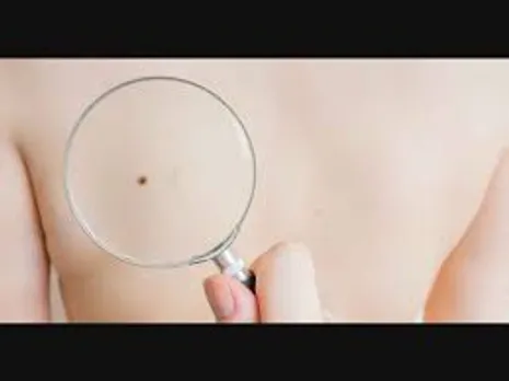 എന്താണ് മെലനോമ?എന്തുകൊണ്ട് പുരുഷന്മാരില്‍ കൂടുതല്‍?ലക്ഷണങ്ങള്‍ ഇവയാണ്....