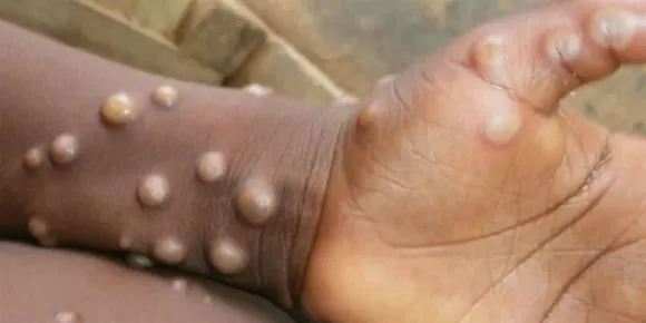 ഇന്ത്യയിലും കുരങ്ങുപനി? സാമ്പിൾ വിദ​ഗ്ധ പരിശോധനയ്ക്ക് അയച്ചു