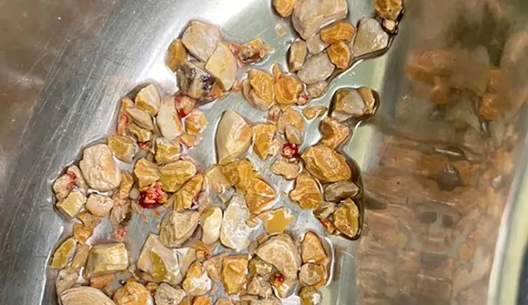 ഒരു മണിക്കൂര്‍ നീണ്ടു നിന്ന ശസ്ത്രക്രിയ! ഹൈദരാബാദില്‍ 56-കാരന്റെ വൃക്കയില്‍ നിന്ന് നീക്കം ചെയ്തത് 206 കല്ലുകള്‍