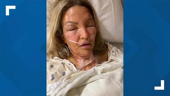 സാനിറ്റൈസർ പൊട്ടിത്തെറിച്ചു വീട്ടമ്മയ്ക്കു ഗുരുതര പരുക്ക്